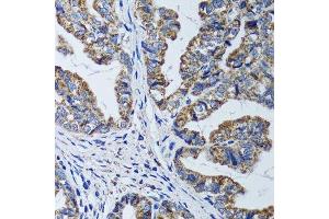 Immunohistochemistry of paraffin-embedded human gastric cancer using ATP5B antibody. (ATP5B Antikörper  (AA 230-529))