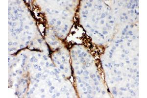 Anti-CA1 Picoband antibody, IHC(P) IHC(P): Human Liver Cancer Tissue (CA1 Antikörper  (AA 9-261))