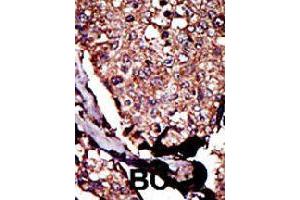 Formalin-fixed and paraffin-embedded human cancer tissue reacted with DGKB polyclonal antibody  , which was peroxidase-conjugated to the secondary antibody, followed by DAB staining. (DGKB Antikörper  (C-Term))