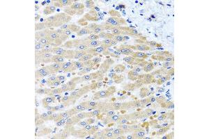 Immunohistochemistry of paraffin-embedded human liver injury using DARS2 antibody at dilution of 1:100 (x40 lens). (DARS2 Antikörper)