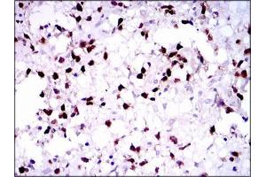 Immunohistochemical analysis of paraffin-embedded brain tumors tissues using PAX5 mouse mAb with DAB staining. (PAX5 Antikörper  (AA 235-382))