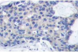 Immunohistochemistry (IHC) analyzes of p-ZAP-70 antibody in paraffin-embedded human breast carcinoma tissue. (ZAP70 Antikörper  (pTyr493))