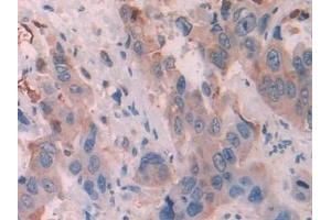 Detection of KRT6C in Human Breast cancer Tissue using Polyclonal Antibody to Keratin 6C (KRT6C) (Keratin 6C Antikörper  (AA 163-482))