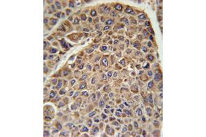 DLAT Antibody (C-term) (ABIN651534 and ABIN2840283) immunohistochemistry analysis in formalin fixed and paraffin embedded human hepatocarcinoma followed by peroxidase conjugation of the secondary antibody and DAB staining. (DLAT Antikörper  (C-Term))