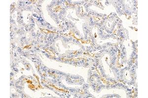 ABIN6263368 and ABIN6279540 at 1/100 staining human liver cancer by IHC-P. (MRPL33 Antikörper  (Internal Region))