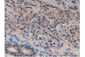 IHC-P analysis of Human Prostate Gland Cancer Tissue, with DAB staining. (FUCA1 Antikörper  (AA 53-289))