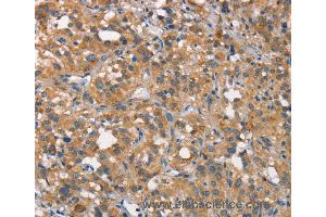 Immunohistochemistry of Human gastric cancer using CEACAM6 Polyclonal Antibody at dilution of 1:50