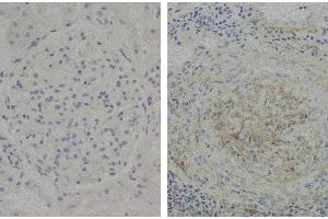 Paraffin embedded glomerular basement membrane tissue sections from patients with Anti-GBM disease were stained with Mouse Anti-Human IgG2 Fd-UNLB (Maus anti-Human IgG2 (Fd Region) Antikörper)