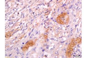Formalin-fixed and paraffin embedded human lung carcinoma labeled with Anti-CD63/MLA1 Polyclonal Antibody, Unconjugated  at 1:200 followed by conjugation to the secondary antibody and DAB staining.