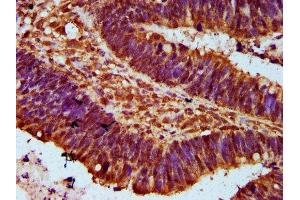 IHC image of ABIN7152566 diluted at 1:300 and staining in paraffin-embedded human ovarian cancer performed on a Leica BondTM system. (FAN1 Antikörper  (AA 167-373))