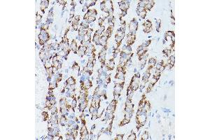 Immunohistochemistry of paraffin-embedded Human thyroid cancer using RPS18 antibody (ABIN6128660, ABIN6147205, ABIN6147206 and ABIN6215379) at dilution of 1:100 (40x lens). (RPS18 Antikörper  (AA 1-152))