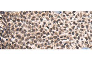 Immunohistochemistry of paraffin-embedded Human ovarian cancer tissue using CITED2 Polyclonal Antibody at dilution of 1:50(x200) (CITED2 Antikörper)