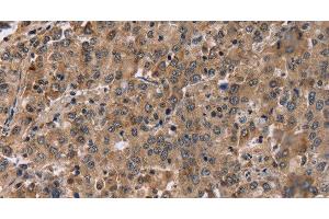 Immunohistochemistry of paraffin-embedded Human liver cancer tissue using FAM107A Polyclonal Antibody at dilution 1:30 (FAM107A Antikörper)