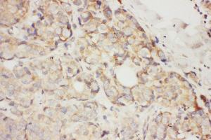 Anti-SCF antibody, IHC(P) IHC(P): Human Mammary Cancer Tissue (KIT Ligand Antikörper  (N-Term))