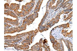 The image on the left is immunohistochemistry of paraffin-embedded Human esophagus cancer tissue using ABIN7193075(XKR4 Antibody) at dilution 1/20, on the right is treated with synthetic peptide. (XKR4 Antikörper)