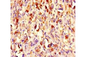 Immunohistochemistry of paraffin-embedded human melanoma using ABIN7147720 at dilution of 1:100 (CHD4 Antikörper  (AA 1-219))