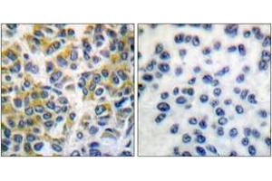 Immunohistochemistry analysis of paraffin-embedded human breast carcinoma tissue, using SHP-1 (Ab-536) Antibody. (SHP1 Antikörper  (AA 502-551))