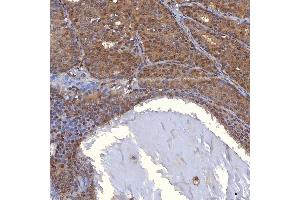 IHC analysis of PIG3/TP53I3 using anti-PIG3/TP53I3 antibody (ABIN7599280). (TP53I3 Antikörper  (AA 1-332))