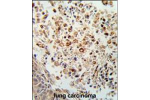 Formalin-fixed and paraffin-embedded human lung carcinoma reacted with FPRL2 Antibody , which was peroxidase-conjugated to the secondary antibody, followed by DAB staining. (FPR3 Antikörper  (AA 307-333))