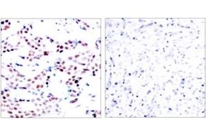Immunohistochemistry analysis of paraffin-embedded human breast carcinoma, using c-Jun (Phospho-Thr91) Antibody. (C-JUN Antikörper  (pThr91))