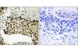 Immunohistochemistry analysis of paraffin-embedded human breast carcinoma, using MSK1 (Phospho-Ser212) Antibody.