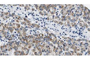 ABIN6274580 at 1/100 staining Human liver cancer tissue by IHC-P.