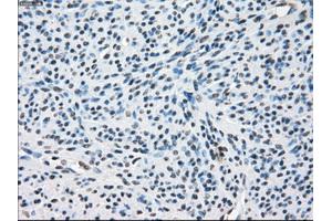 Immunohistochemical staining of paraffin-embedded Adenocarcinoma of colon tissue using anti-ZFP36 mouse monoclonal antibody. (ZFP36 Antikörper)
