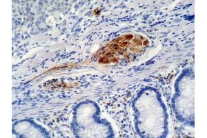 Immunohistochemistry staining of colon carcinoma (paraffin-embedded sections) with anti-p21 (WA-1).