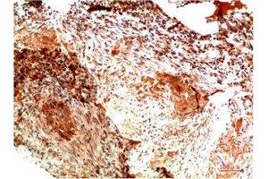 Immunohistochemical analysis of paraffin-embedded Human Lung Carcinoma Tissue using Collagen II Mouse mAb diluted at 1:200. (COL2A1 Antikörper)