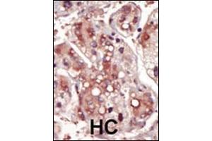 Formalin-fixed and paraffin-embedded human cancer tissue reacted with the primary antibody, which was peroxidase-conjugated to the secondary antibody, followed by DAB staining. (MEK2 Antikörper  (AA 262-292))