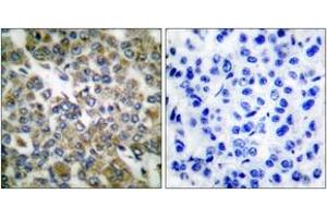 Immunohistochemistry analysis of paraffin-embedded human breast carcinoma tissue, using Keratin 14 Antibody. (KRT14 Antikörper  (AA 1-50))