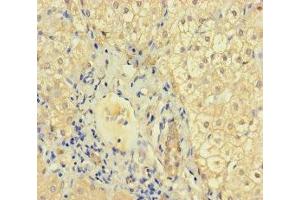 Immunohistochemistry of paraffin-embedded human liver cancer using ABIN7157448 at dilution of 1:100 (Keratin 71 Antikörper  (AA 201-500))