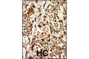 Formalin-fixed and paraffin-embedded human cancer tissue reacted with the primary antibody, which was peroxidase-conjugated to the secondary antibody, followed by AEC staining. (MOS Antikörper  (N-Term))