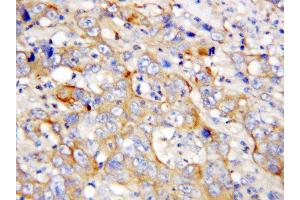 Anti-PF4 antibody, IHC(P) IHC(P): Human Lung Cancer Tissue (PF4 Antikörper  (C-Term))