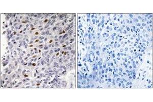 Immunohistochemistry analysis of paraffin-embedded human lung carcinoma tissue, using ATF1 (Ab-63) Antibody. (AFT1 Antikörper  (AA 31-80))