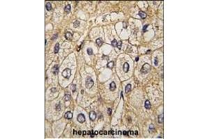 Formalin-fixed and paraffin-embedded human hepatocarcinoma tissue reacted with EphA7 antibody (ABIN391900 and ABIN2841718) , which was peroxidase-conjugated to the secondary antibody, followed by DAB staining.