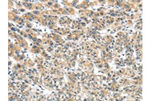 The image on the left is immunohistochemistry of paraffin-embedded Human liver cancer tissue using ABIN7131474(TRIM16 Antibody) at dilution 1/35, on the right is treated with fusion protein. (TRIM16 Antikörper)