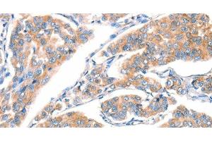 Immunohistochemistry of paraffin-embedded Human breast cancer using CD297 Polyclonal Antibody at dilution of 1:30 (ART4 Antikörper)