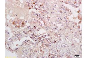 Formalin-fixed and paraffin embedded human lung carcinoma labeled with Anti-PKA/PKAcat/PKACB Polyclonal Antibody, Unconjugated (ABIN669576) at 1:200 followed by conjugation to the secondary antibody and DAB staining.