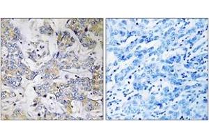 Immunohistochemistry analysis of paraffin-embedded human breast carcinoma tissue, using RPL37 Antibody. (RPL37 Antikörper  (AA 21-70))