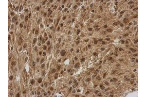 IHC-P Image Immunohistochemical analysis of paraffin-embedded U373 xenograft, using FGF13, antibody at 1:500 dilution. (FGF13 Antikörper)