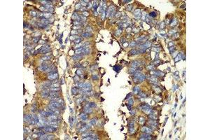 Immunohistochemistry of paraffin-embedded Human colon carcinoma using QARS Polyclonal Antibody at dilution of 1:100 (40x lens). (QARS Antikörper)