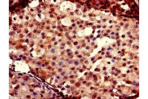Immunohistochemistry of paraffin-embedded human breast cancer using ABIN7153026 at dilution of 1:100 (FOXC2 Antikörper  (AA 24-294))