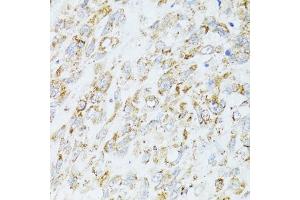 Immunohistochemistry of paraffin-embedded human lung cancer using EGFR antibody (ABIN6133679, ABIN6139975, ABIN6139980 and ABIN6215265) at dilution of 1:100 (40x lens). (EGFR Antikörper  (AA 960-1060))