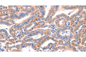 Immunohistochemistry of paraffin-embedded Human thyroid cancer tissue using AP1B1 Polyclonal Antibody at dilution 1:70 (AP1B1 Antikörper)