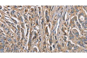 Immunohistochemistry of paraffin-embedded Human prostate cancer tissue using ABI3BP Polyclonal Antibody at dilution 1:60 (ABI3BP Antikörper)