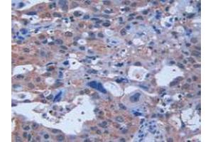 IHC-P analysis of Human Breast Cancer Tissue, with DAB staining. (Retinoic Acid Receptor alpha Antikörper  (AA 68-173))