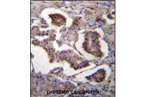 GUF1 Antibody (N-term) (ABIN656785 and ABIN2846003) immunohistochemistry analysis in formalin fixed and paraffin embedded human prostate carcinoma followed by peroxidase conjugation of the secondary antibody and DAB staining. (GUF1 Antikörper  (N-Term))