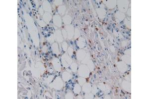 Used in DAB staining on fromalin fixed paraffin- embedded skin cancer tissue (CSF2RA Antikörper  (AA 28-112))