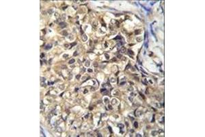 Immunohistochemistry analysis in formalin fixed and paraffin embedded human breast carcinoma reacted with KLHL35 Antibody (C-term) followed by peroxidase conjugation of the secondary antibody and DAB staining.